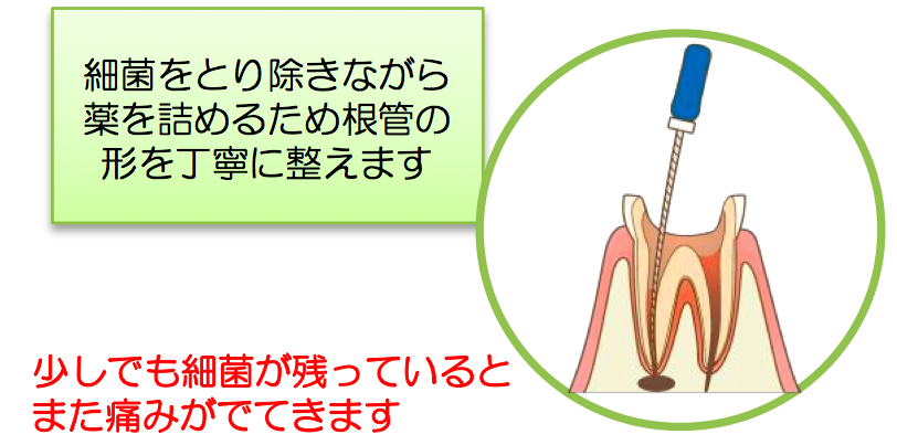 根の治療